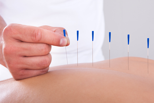 Akupunktur Nedir? Kimlere, Nasıl Uygulanır?