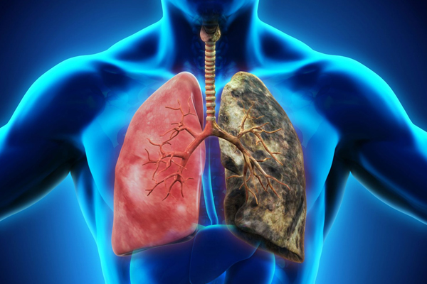Akciğer Kanseri Nedir? Belirtileri, Teşhisi ve Risk Faktörleri