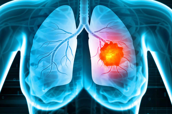 Akciğer Kanserinin 8 Önemli Sinyali